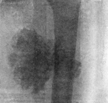 Fig. 151.—Radiogram of Osteo-Sarcoma of Upper Third of Femur.