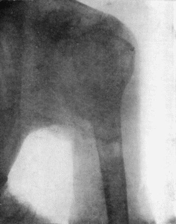 Fig. 152.—Radiogram of Chondro-Sarcoma of Upper End of Humerus in a woman æt. 29.