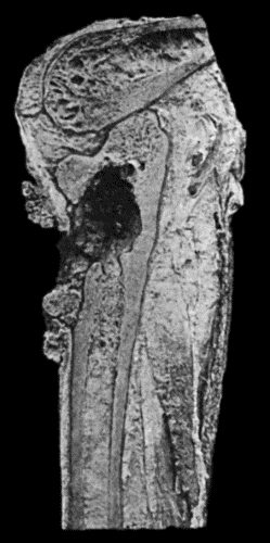 Fig. 153.—Epitheliomatous Ulcer of Leg with direct extension to Tibia. (Lord Lister's specimen. Anatomical Museum, University of Edinburgh.)