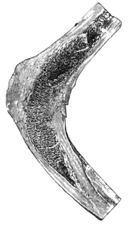 Fig. 154.—Osseous Ankylosis of Femur and Tibia in position of flexion.