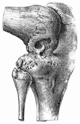 Fig. 155.—Osseous Ankylosis of Knee in the flexed position following upon Tuberculous Arthritis. (Anatomical Museum, University of Edinburgh.)