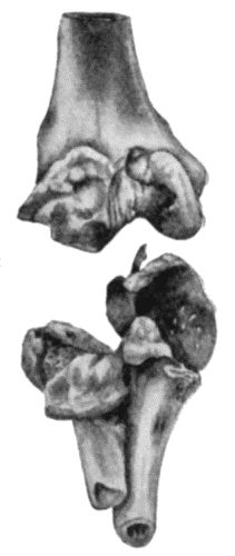 Fig. 157.—Arthritis Deformans of Elbow, showing destruction of articular surfaces and masses of new bone around the articular margins.  (Anatomical Museum, University of Edinburgh.)