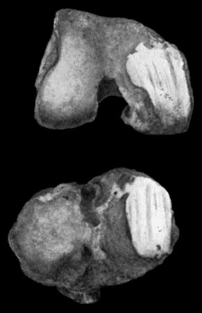 Fig. 158.—Arthritis Deformans of Knee, showing eburnation and grooving of articular surfaces.  (Anatomical Museum, University of Edinburgh.)
