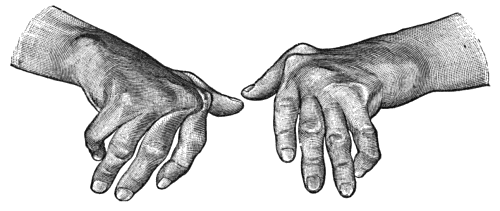 Fig. 160.—Arthritis Deformans of Hands, showing symmetry of lesions, ulnar deviation of fingers, and nodular thickening at inter-phalangeal joints.