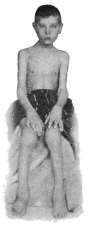 Fig. 161.—Arthritis Deformans affecting several Joints, in a boy æt. 10.  (Dr. Dickson's case.)