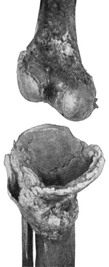 Fig. 162.—Bones of Knee-joint in advanced stage of Charcot's Disease. The medial part of the head of the tibia has disappeared.  (Anatomical Museum, University of Edinburgh).