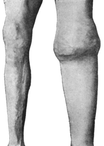 Fig. 163.—Charcot's Disease of Left Knee. The joint is distended with fluid and the whole limb is œdematous.