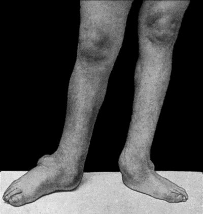 Fig. 164.—Charcot's Disease of both Ankles: front view. Man, æt. 32.