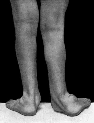 Fig. 165.—Charcot's Disease of both Ankles: back view. Man, æt. 32.