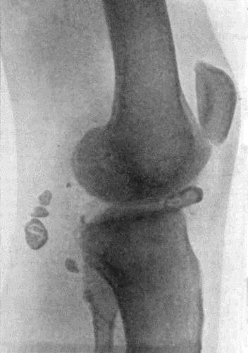 Fig. 166.—Radiogram of Multiple Loose Bodies in Knee-joint and Semi-membranosus Bursa in a man æt. 38. (Mr. J.W. Dowden's case.)