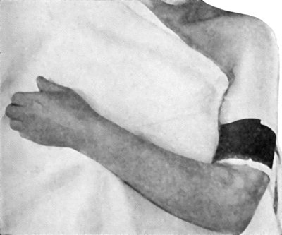 Fig. 6.—Passive Hypermia of Hand and Forearm induced by Bier's Bandage.