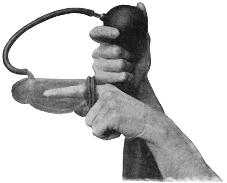 Fig. 7.—Passive Hypermia of Finger induced by Klapp's Suction Bell.